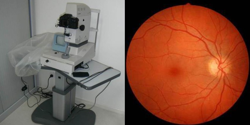 Gp training for diabetic retinopathy screening camera and diabetic retinopathy retinal image
