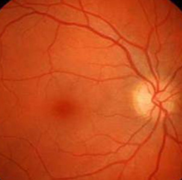 diabetic retinopathy retinal image