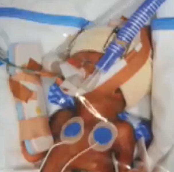 Premature baby